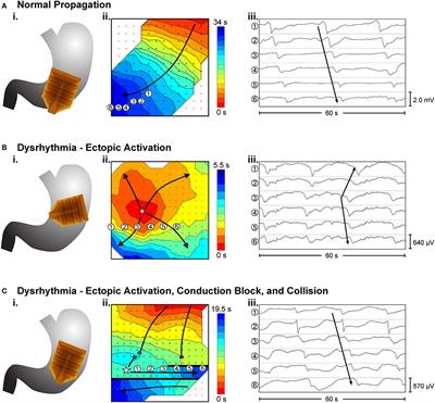 Progress in Mathematical Modeling of Gastrointestinal Slow Wave Abnormalities